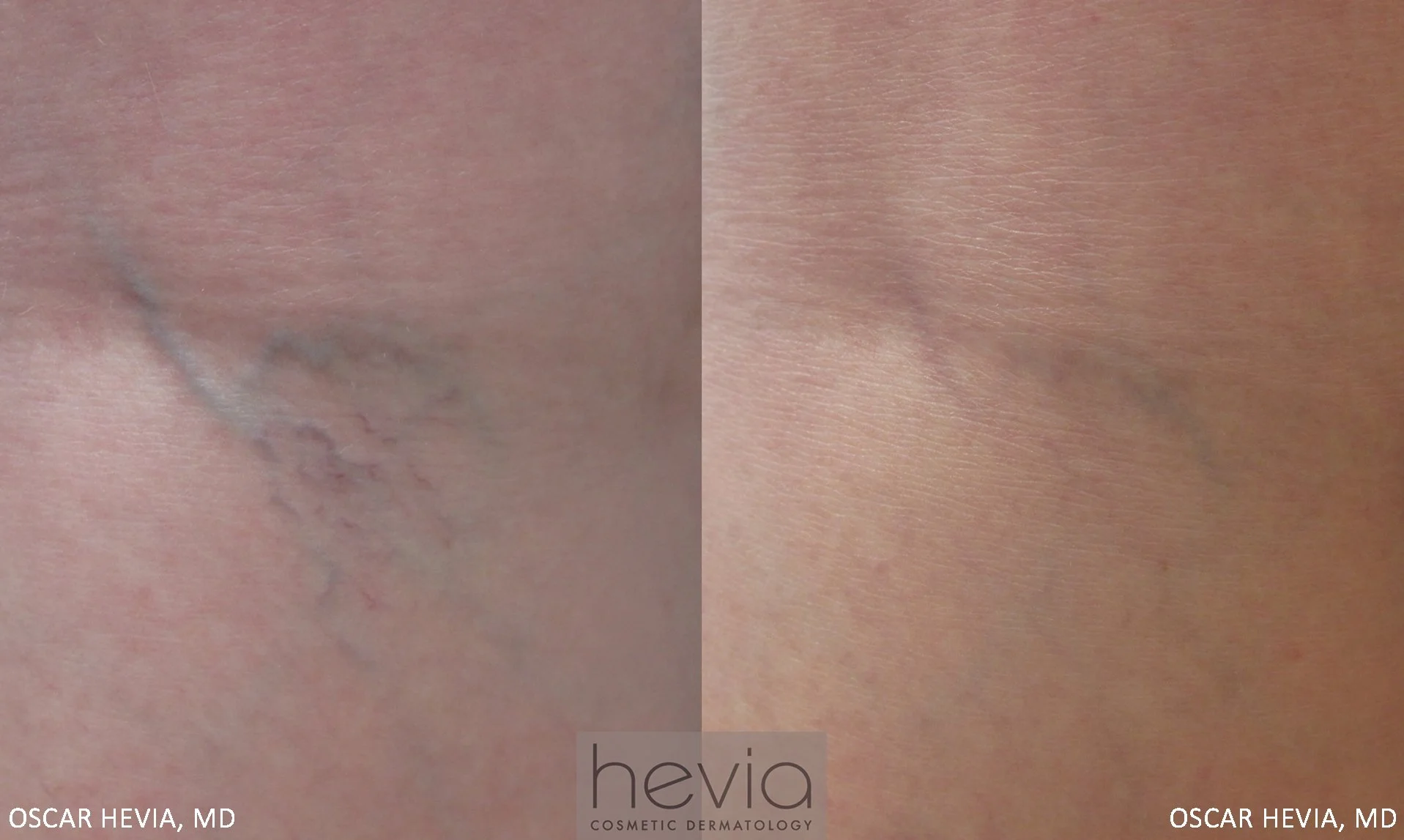 Marked improvement of leg vein after sclerotherapy treatment with Asclera®