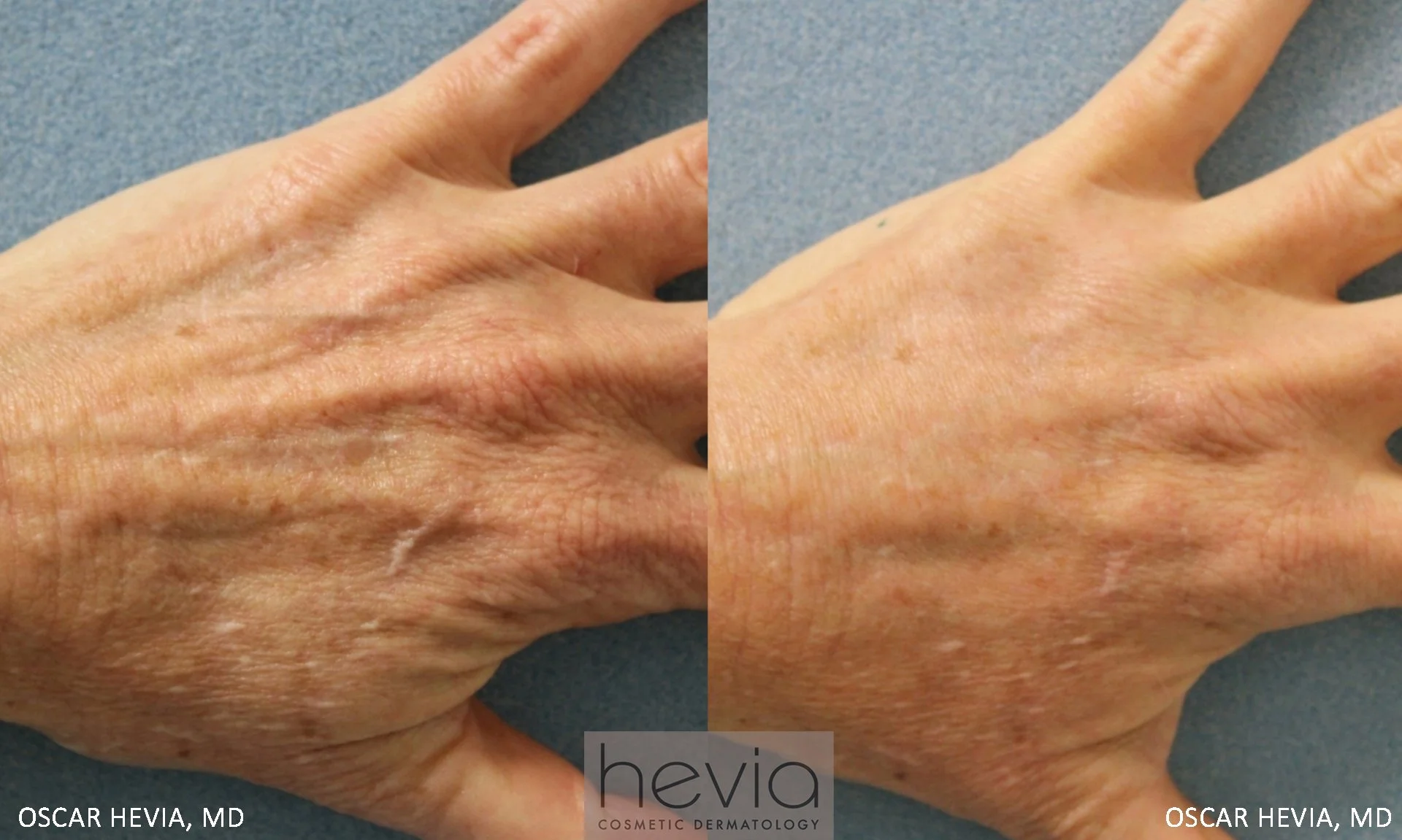 Fuller, more youthful hands after Radiesse® filler treatment.