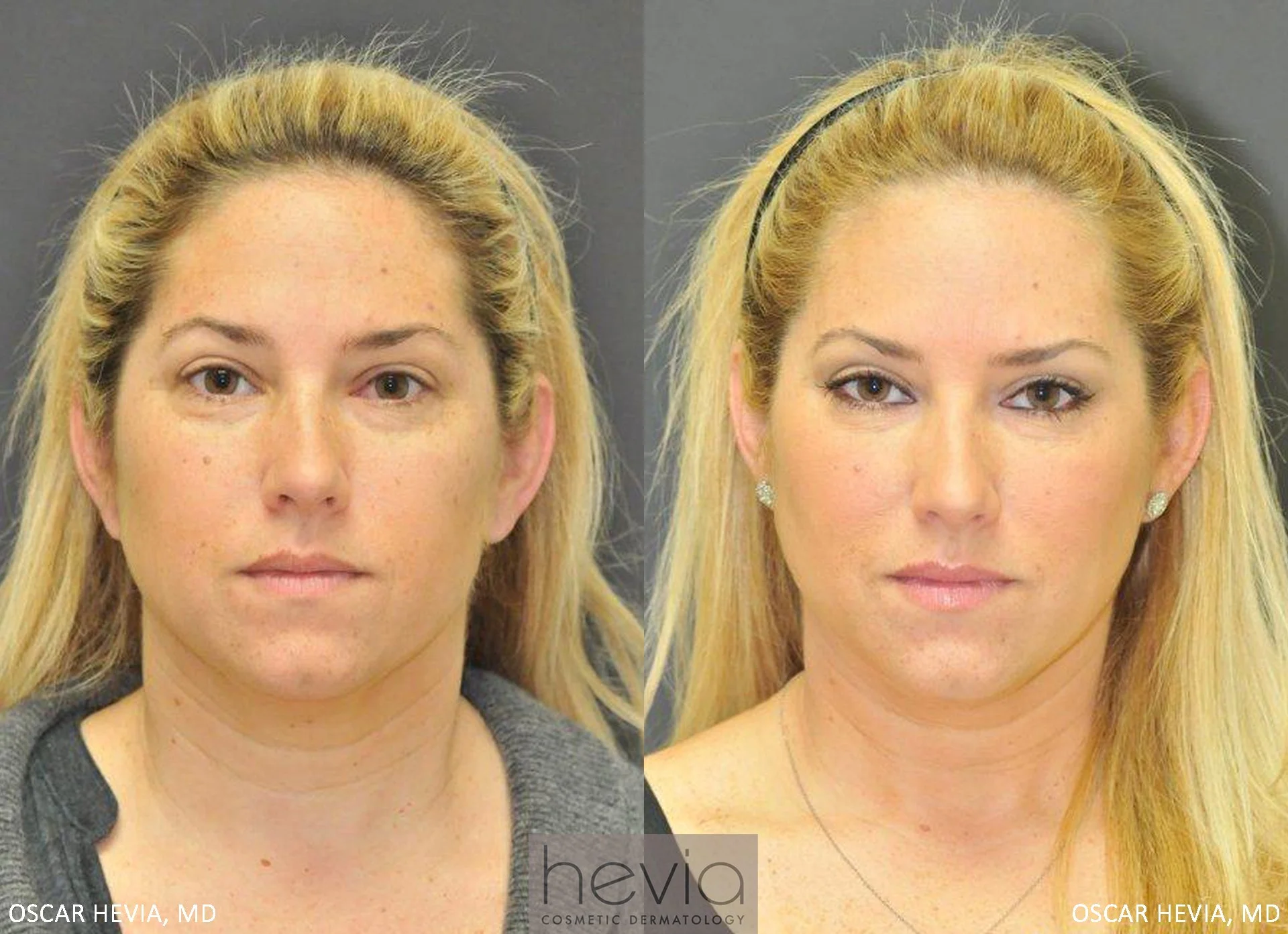 Refreshed, more youthful appearance after Restylane® treatment around the eyes.