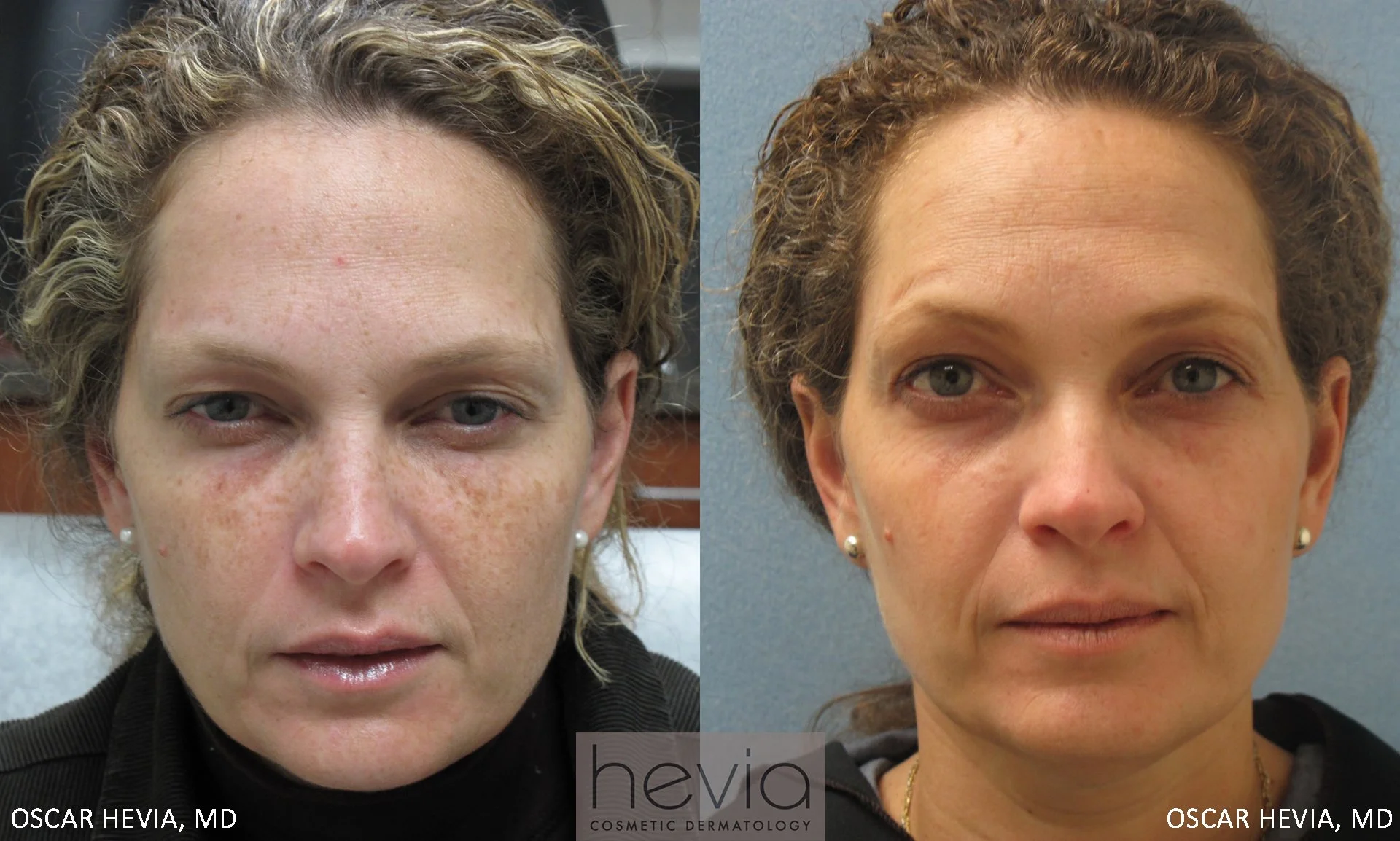 Fading of brown spots after KTP laser and Obagi Nu-Derm® System.