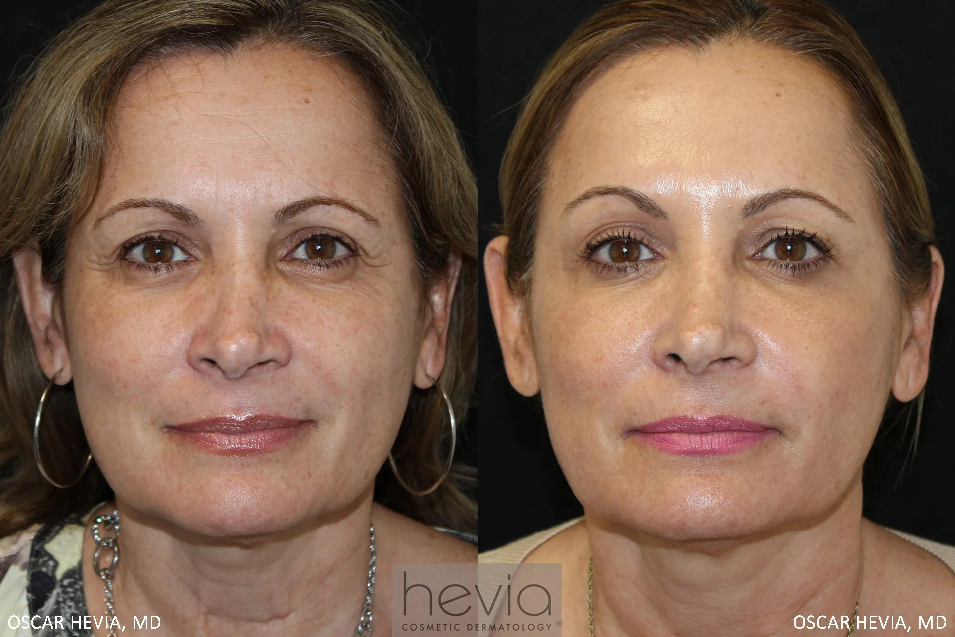 51 year old female with a more youthful, refreshed appearance after Vollure® filler treatment around the eyes and upper face, and Bellafill® filler treatment to the lower face