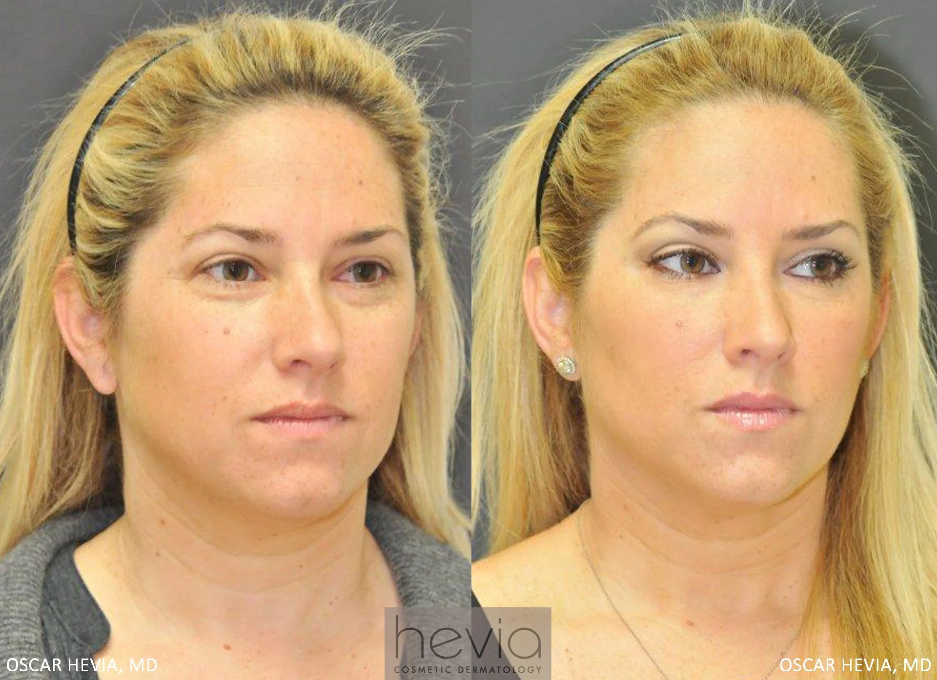 Refreshed, more youthful appearance after Restylane® treatment around the eyes.