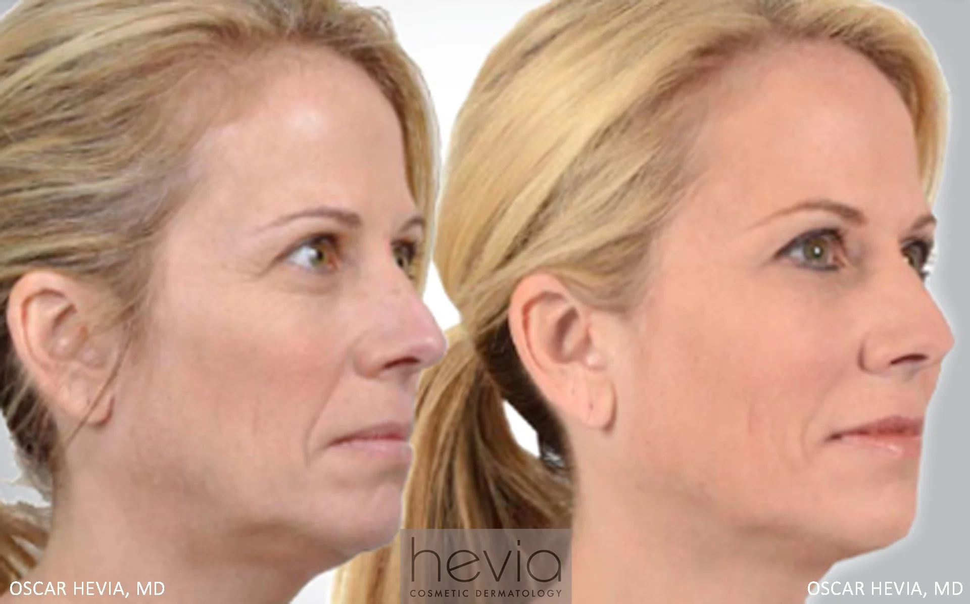 Refreshed and more youthful appearance after Radiesse® and Restylane® to upper and lower face.