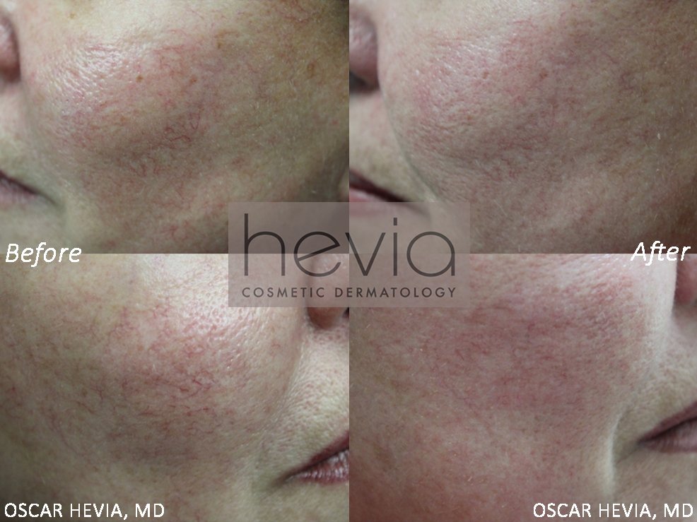 Reduction of facial capillaries after KTP laser treatment.
