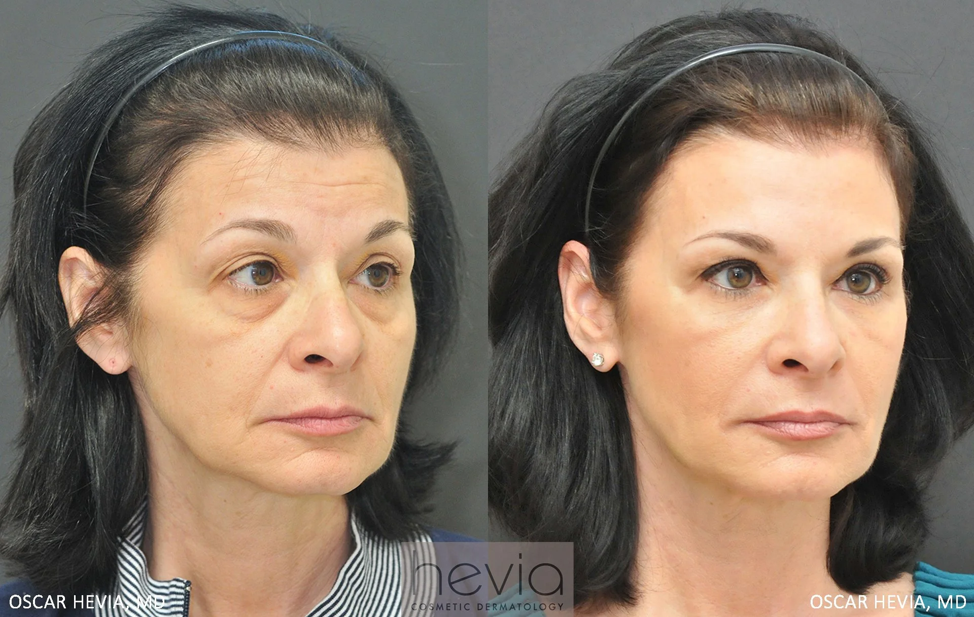 55 year old female with Radiesse® and Restylane® to upper and lower face