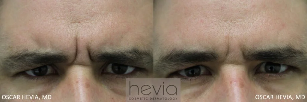 3Botox-Male-before-and-after-1-1024x341.jpg