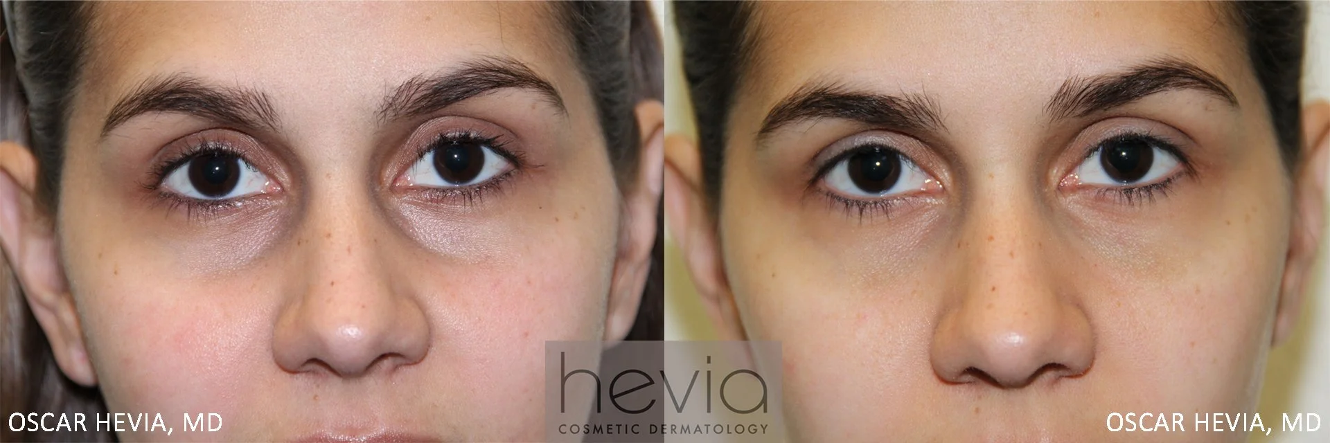 26 year old female after under eye correction.