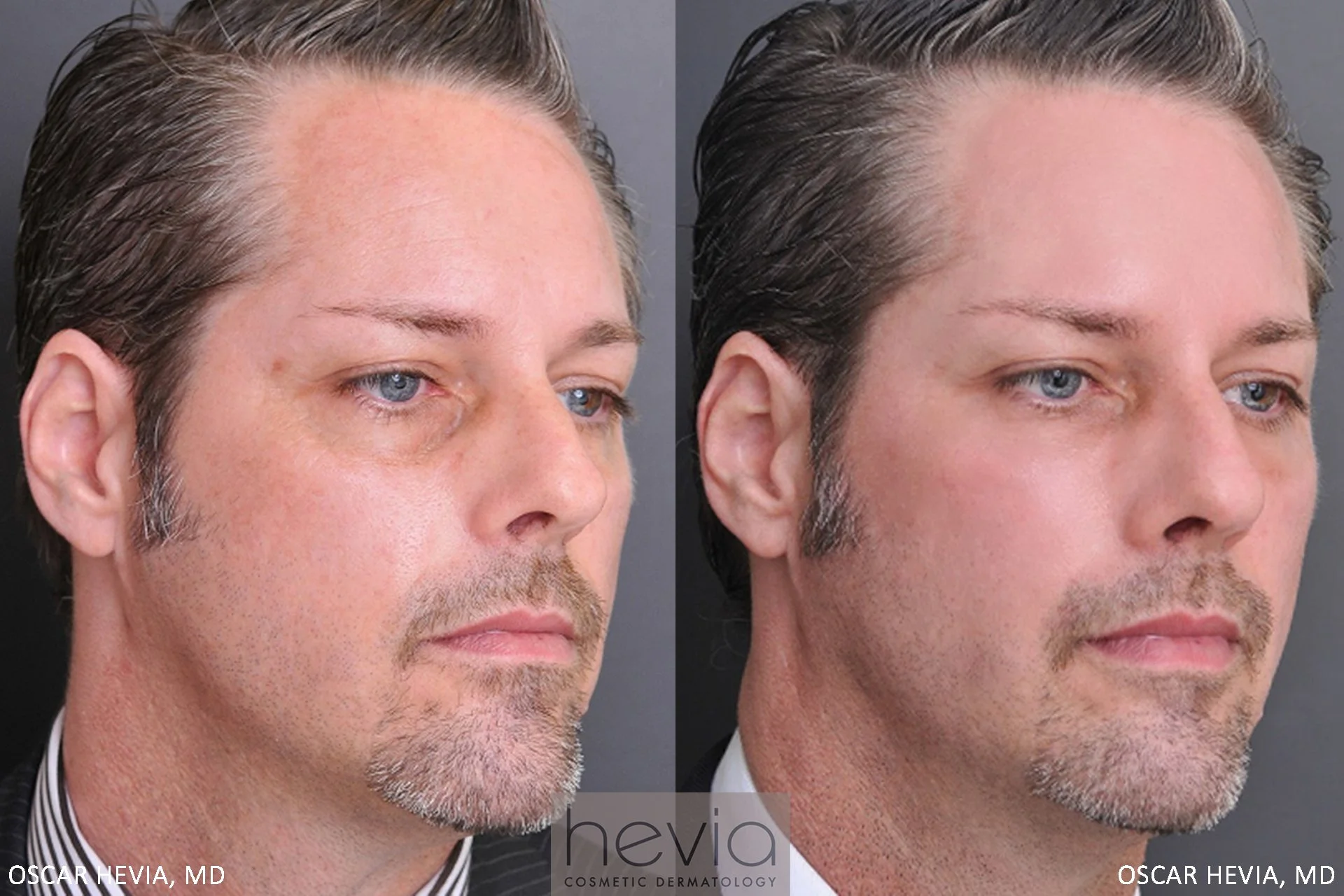 42 year old male after under eye correction with Radiesse®.
