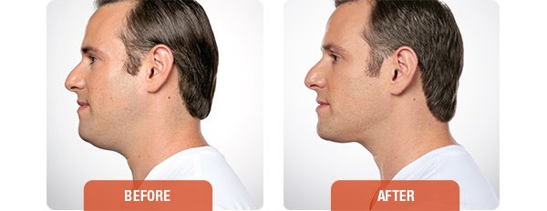 Patients above experienced visible contouring of their chin profile in 2 to 4 treatments.