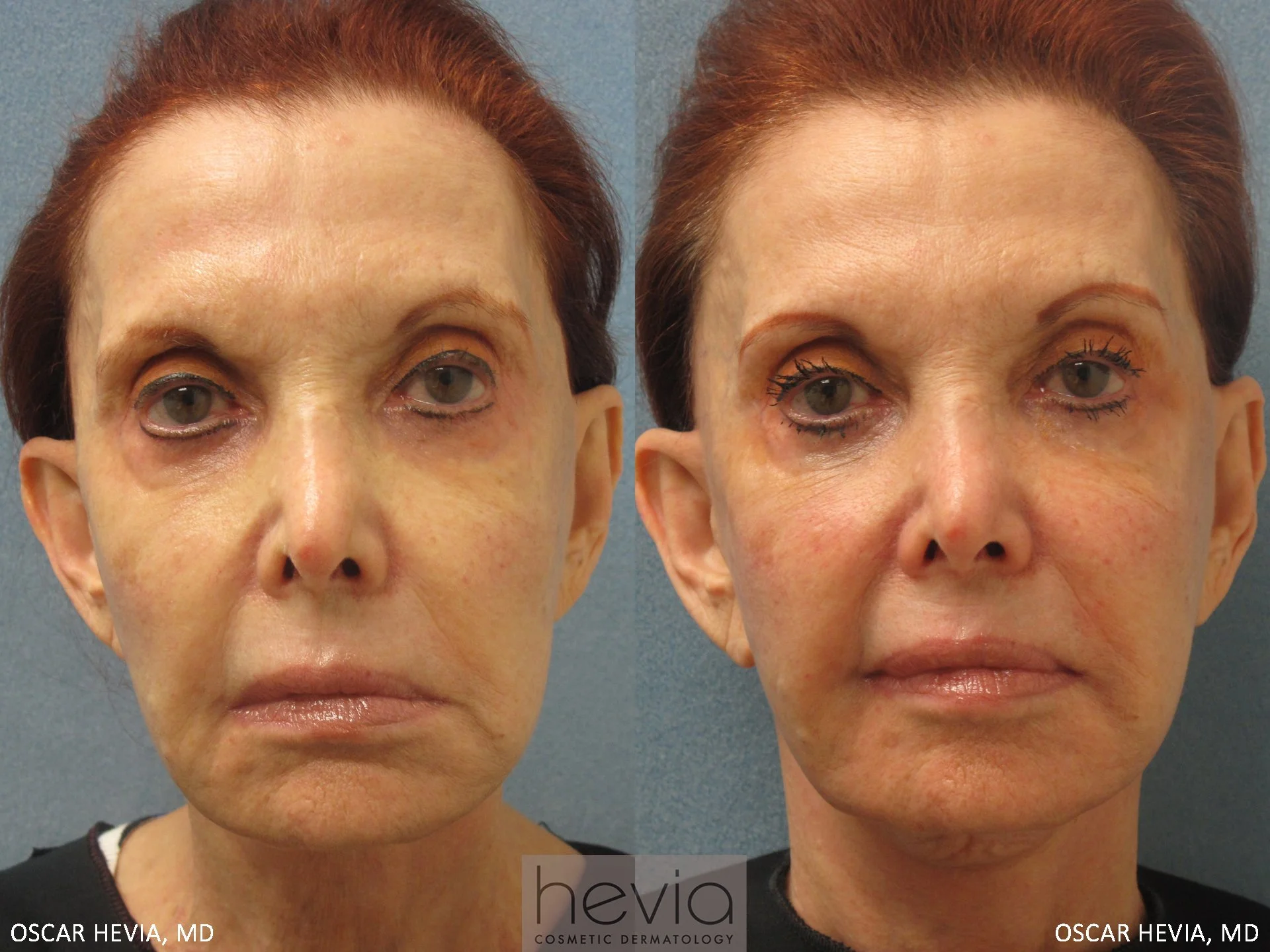 Refreshed, more youthful appearance after Restylane® treatment around the eyes and cheeks.