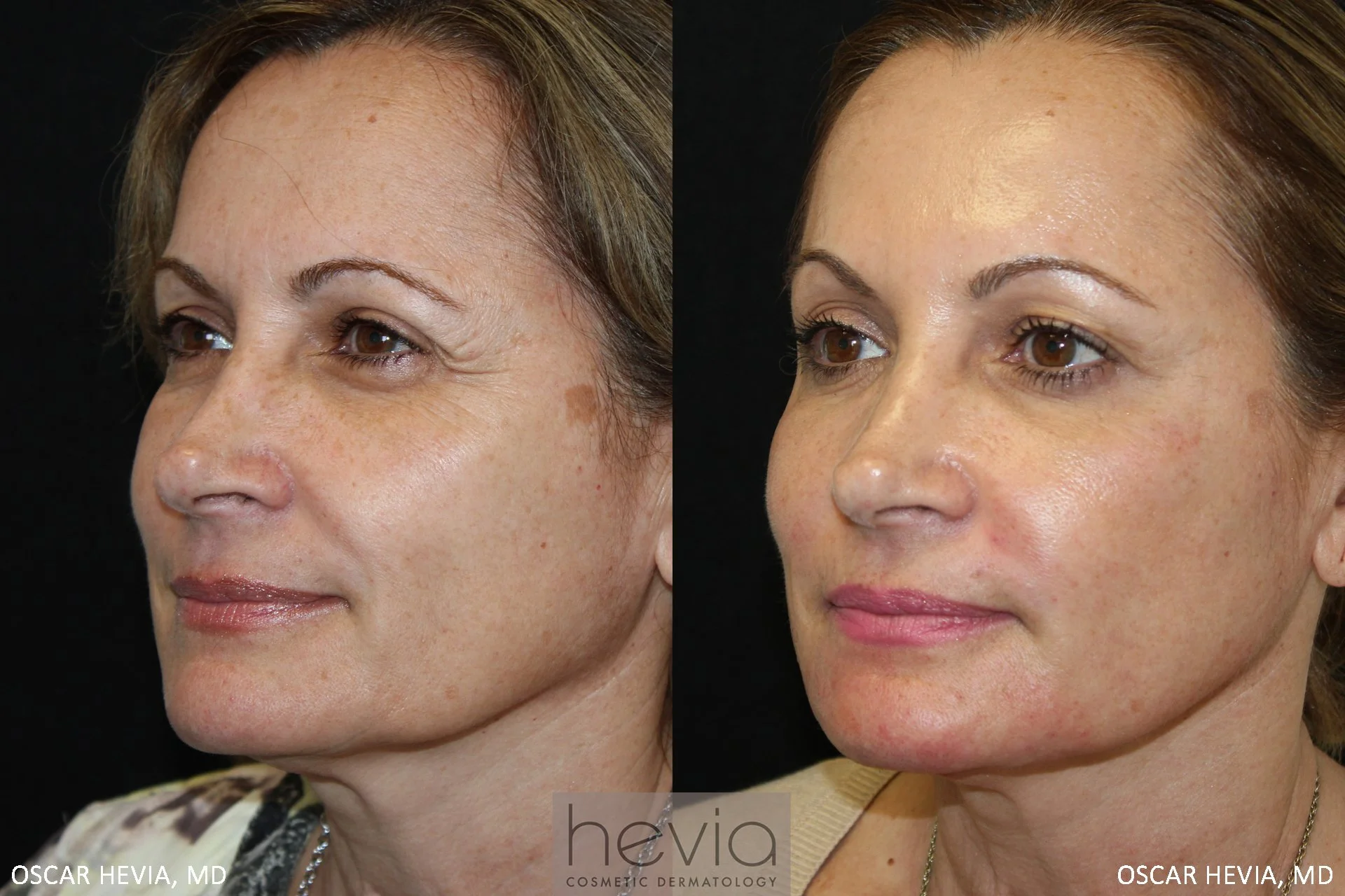 51 year old female with a more youthful, refreshed appearance after Vollure® filler treatment around the eyes and upper face, and Bellafill® filler treatment to the lower face