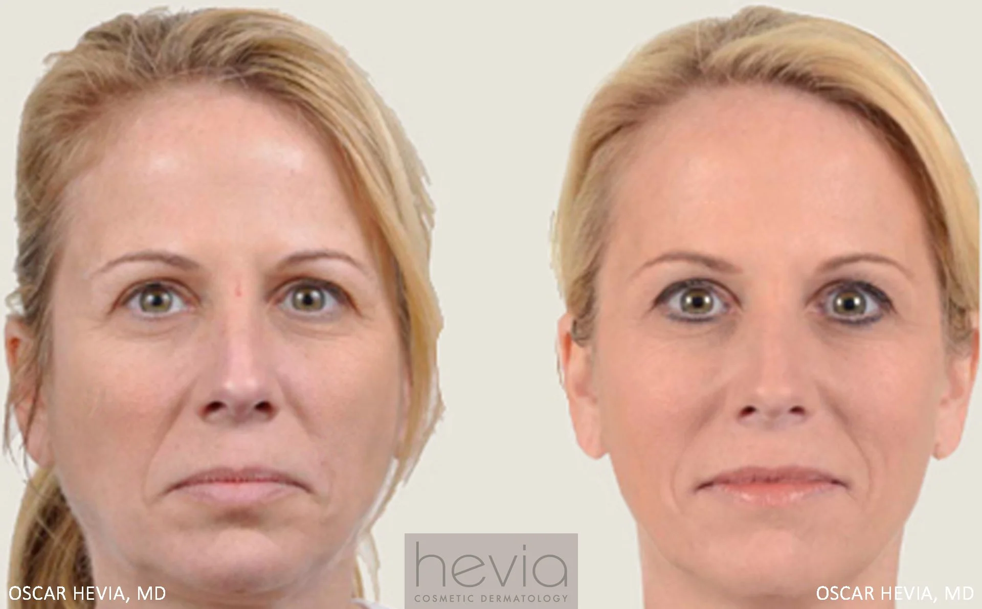 Refreshed and more youthful appearance after Radiesse® and Restylane® to upper and lower face.