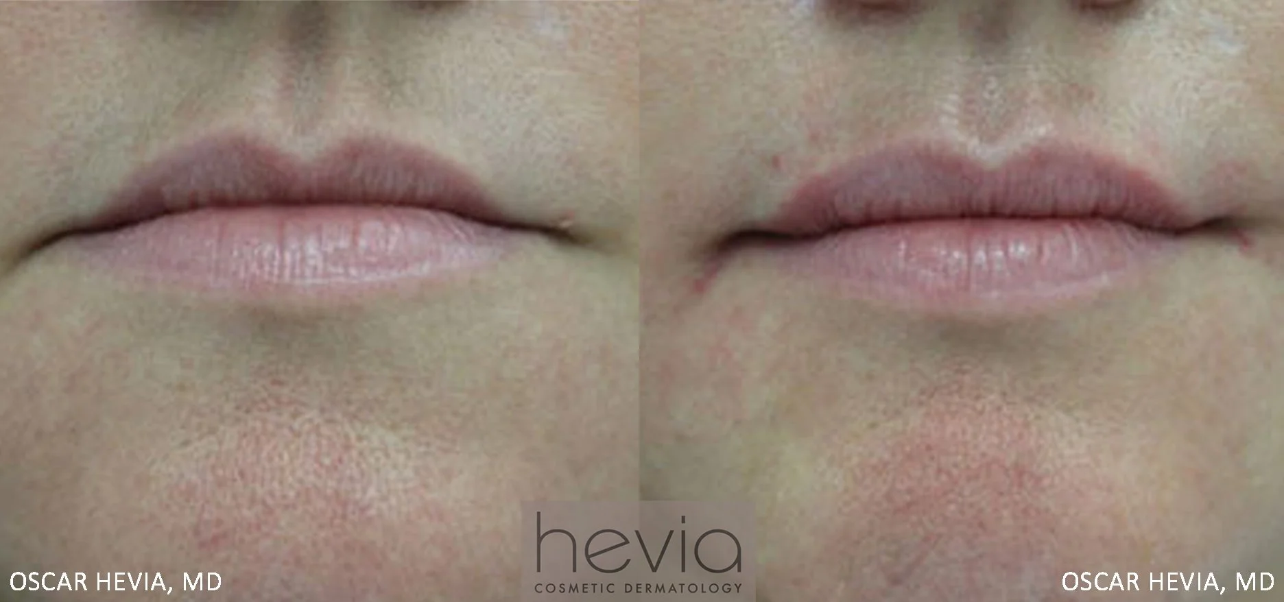 Lip enhancement after Restylane® treatment
