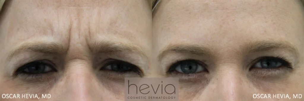 2Botox-Female-before-and-after-1-1024x341.jpg