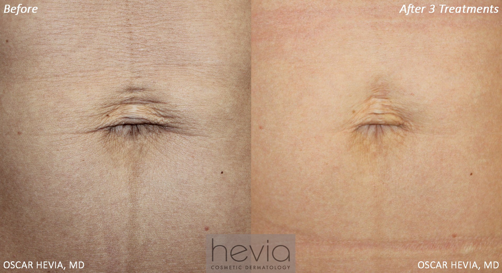 35 year old patient with belly button skin laxity and texture issues after pregnancy.