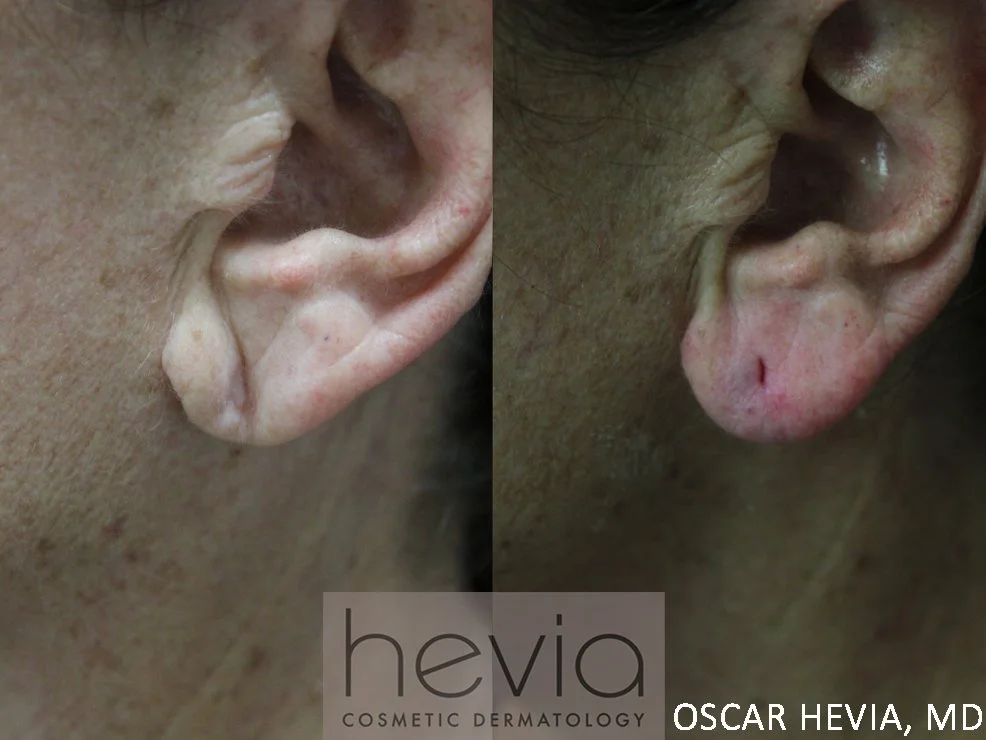 Ear lobe rejuvenation with Radiesse® injectable filler.