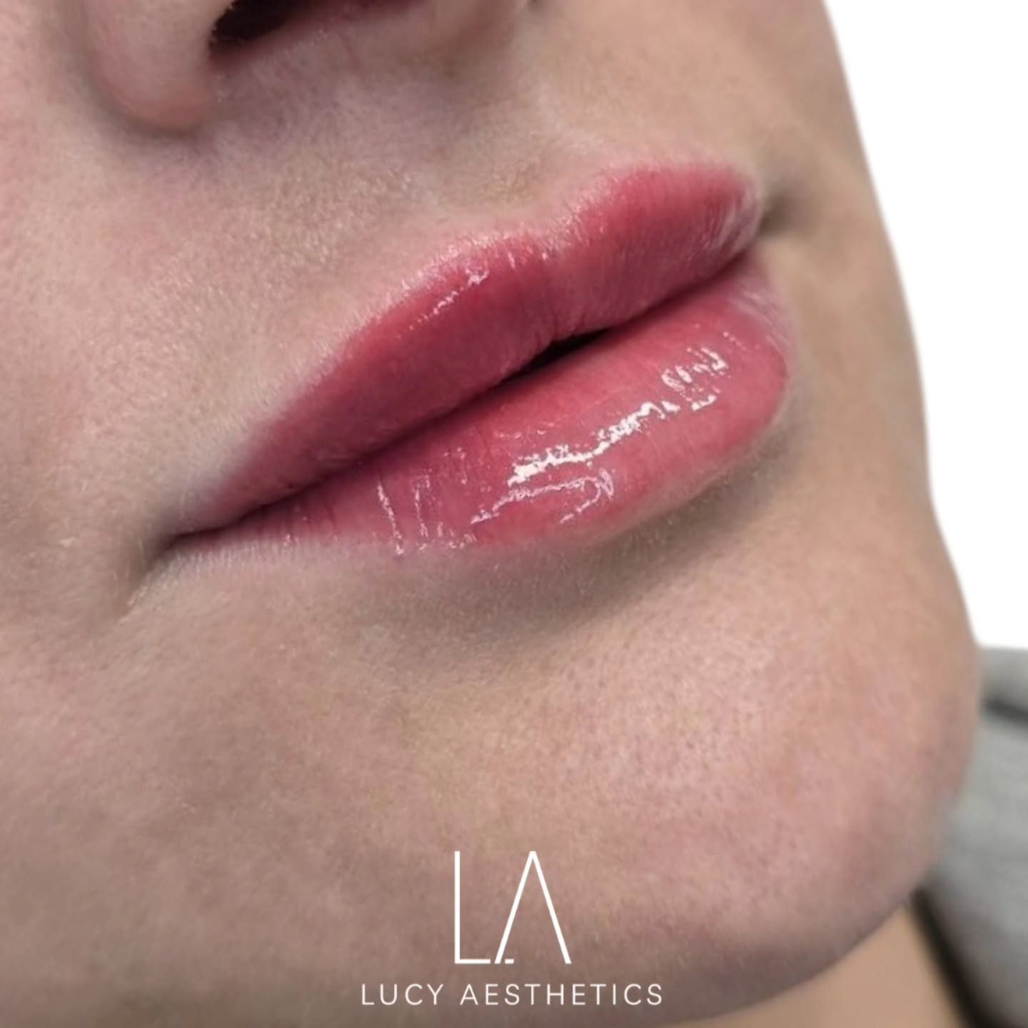 My beautiful patient already had a lovely lip shape, but she wanted to enhance them with more volume and hydration. Creasing in the lips can give them a dehydrated appearance.

I enhanced her lip volume and hydration with a super soft filler across 3