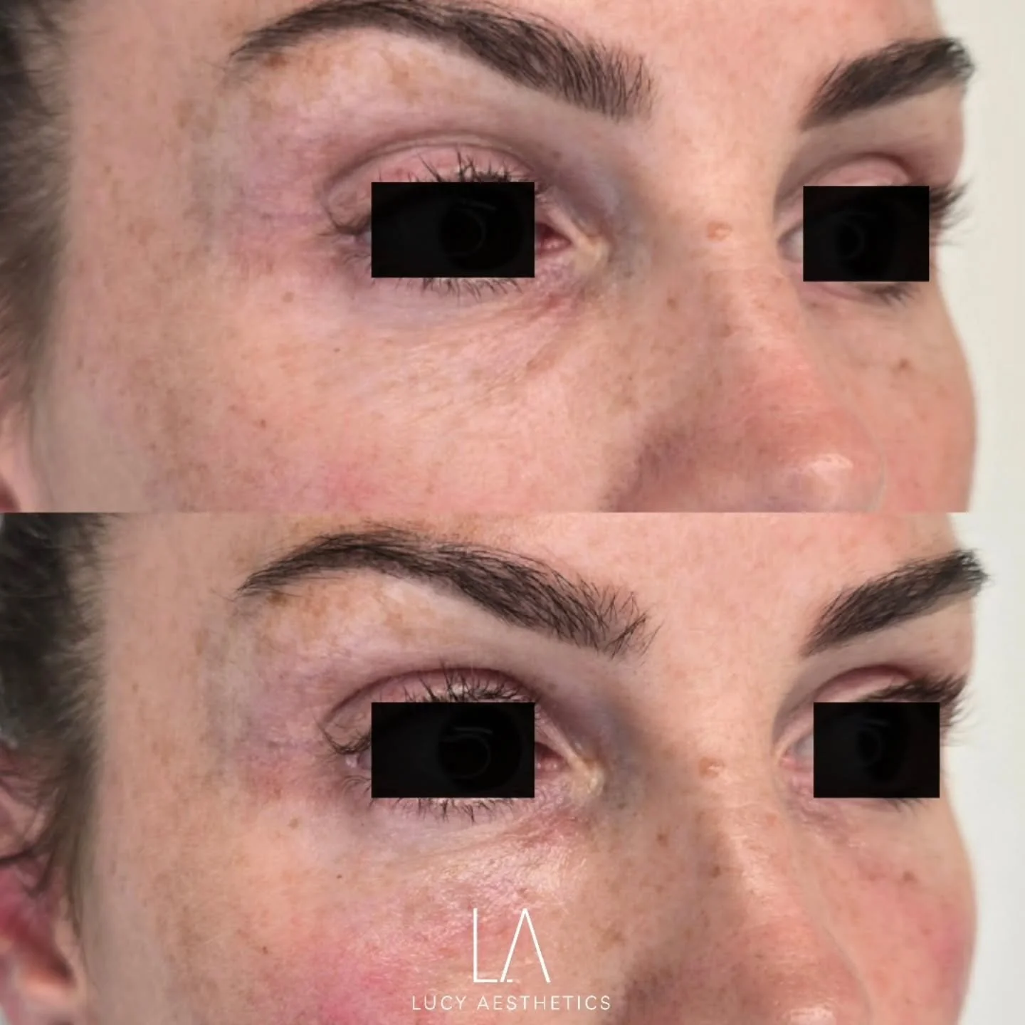 Say goodbye to tired eyes for good.

Meet my beautiful patient, who felt like she always looked exhausted, even after a restful night's sleep. 

On assessment, I could see that my patient has volume loss at the base of her tear trough, resulting in h
