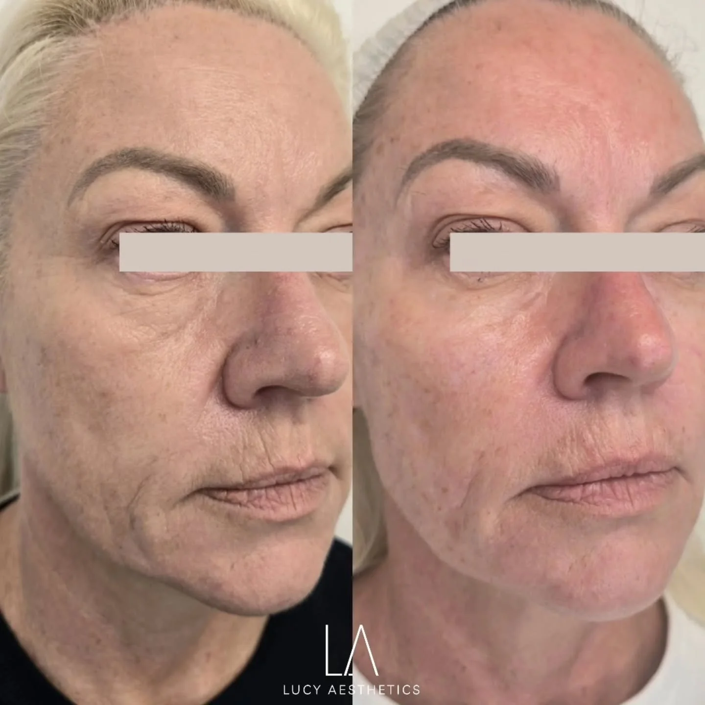 Midface rejuvenation for my lovely patient following weight loss.

As a result of weight loss, the natural fat pads that provide support can diminish, leading to hollowness in the midface and heaviness around the nasolabial folds as facial soft tissu
