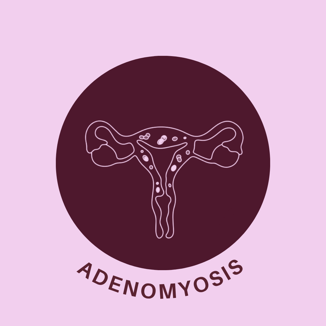 adenomyosis, painful periods, heavy periods