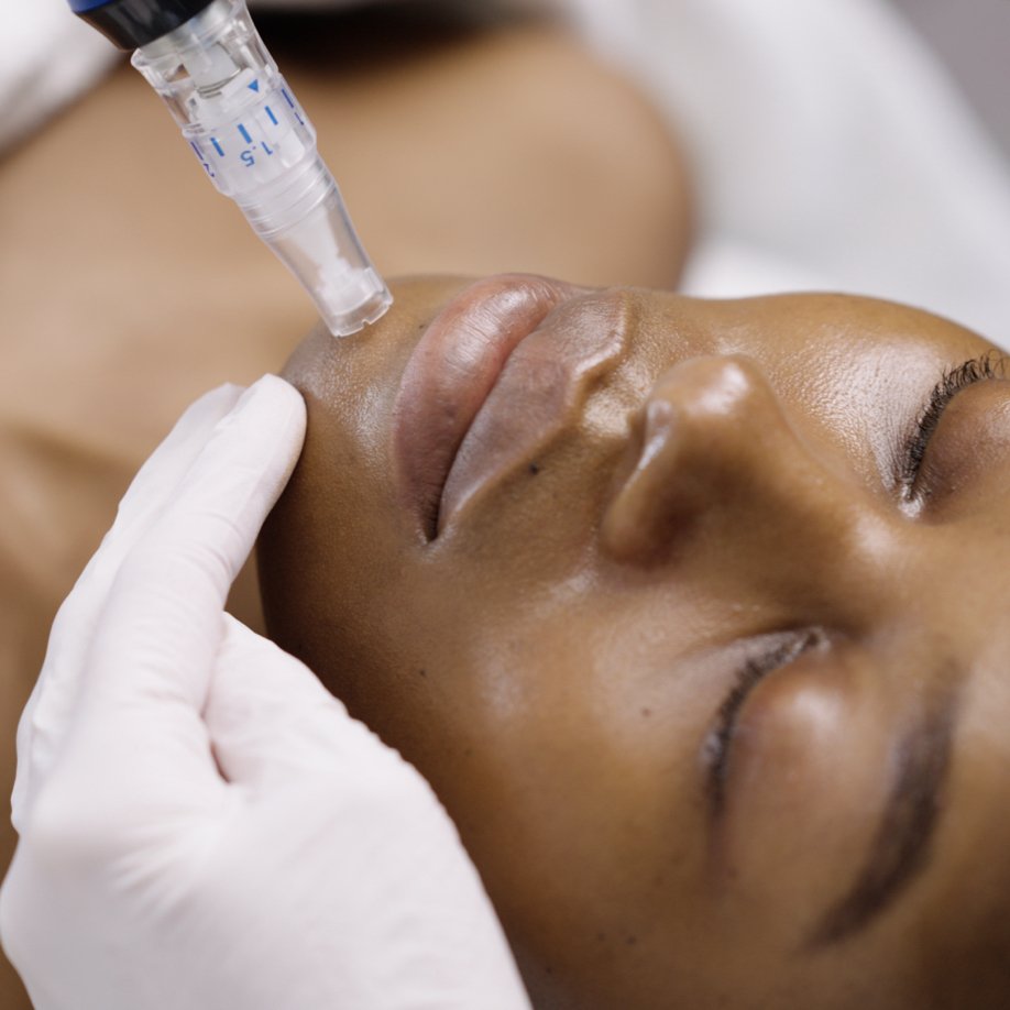 Micro Needling