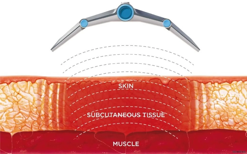 Missachtung der Hautschichten beim Schneiden, zeigt die Haut, subkutanen Gewebe, Muskel und eine Schneide.