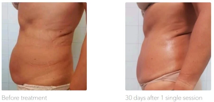 Doppelbild eines männlichen Bauchs, links vor der Behandlung, rechts 30 Tage nach einer Behandlung, zeigt verbesserte Haut und reduziertes Fett.