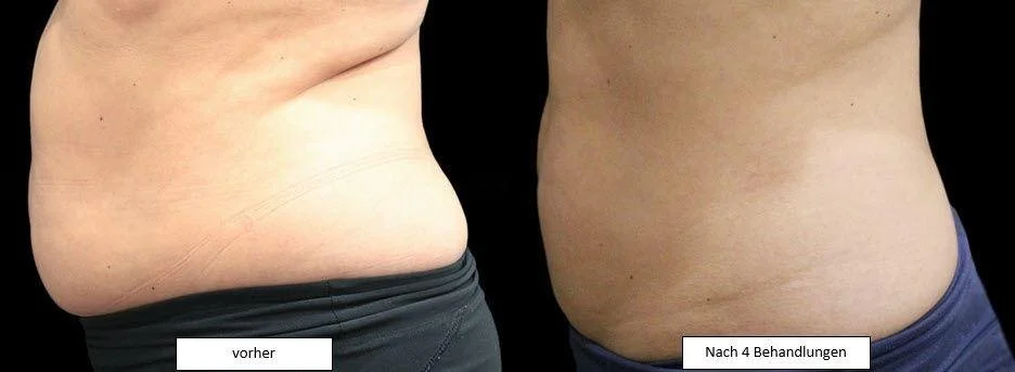 Vergleichsbild eines Bauches vor und nach 4 Behandlungen, links Bauch vor der Behandlung, rechts Bauch nach der Behandlung, mit der Beschriftung 'vorher' und 'Nach 4 Behandlungen'