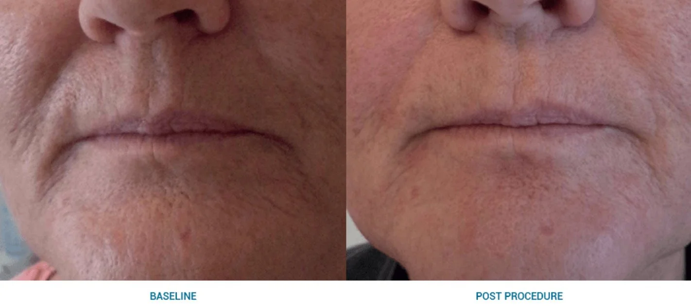 Vorher-Nachher-Vergleich der Lippen und des Kinns einer Person nach einer medizinischen Behandlung.