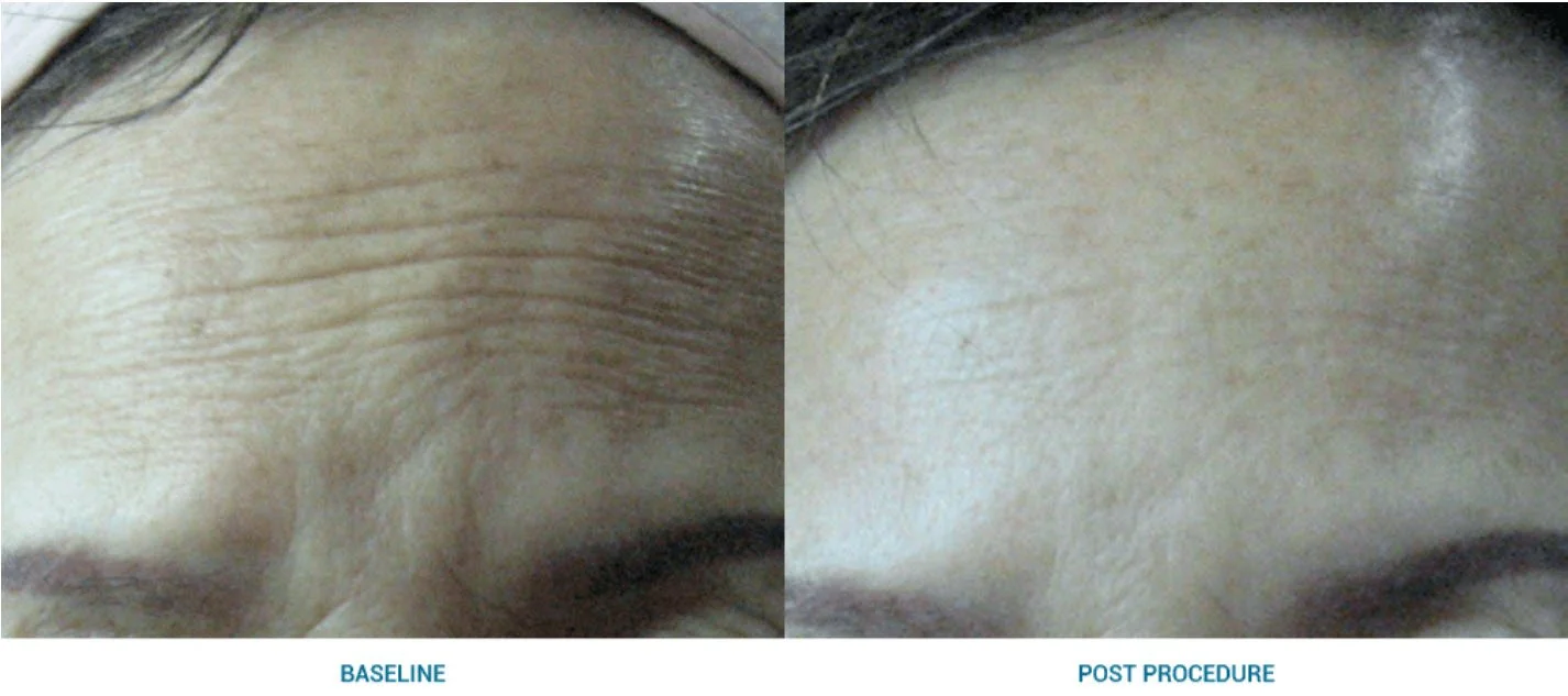 Vergleich der Stirn vor und nach einer Hautbehandlung, links sichtbar Falten und Linien, rechts glatte Haut.