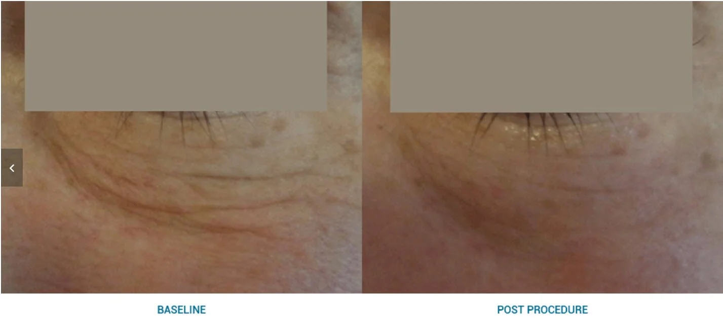 Vergleich eines konturierten Augenbereichs vor und nach einer Behandlung, mit dem Text 'Baseline' und 'Post Procedure'.