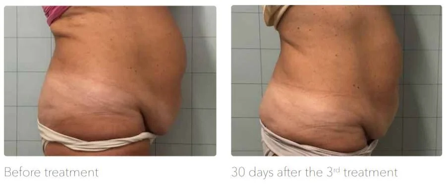 Vergleichsbilder eines Mannes vor und nach einer Behandlung, die sichtbare Verbesserungen bei Bauch und Haut zeigen, mit Textbeschreibungen "Vor der Behandlung" und "30 Tage nach der dritten Behandlung".