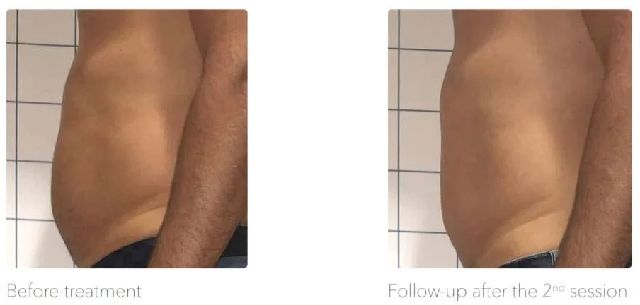 Side view eines männlichen Oberkörpers vor und nach einer Behandlung zur Fettreduktion oder Körperformung, sichtbar auf einem Bildschirm. Links: vor der Behandlung. Rechts: nach der zweiten Sitzung.