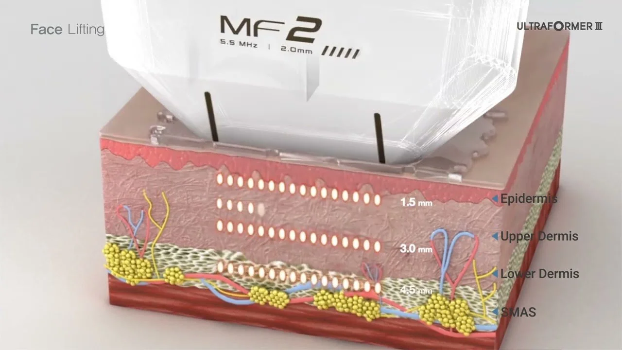 Schematische Darstellung eines Haut-Lasersystems, das auf die Haut schießt. Die Haut ist in Epidermis, Upper Dermis, Lower Dermis und SMAS unterteilt, mit der Entfernung in verschiedenen Dicken. Der Laser trägt zu Face Lifting bei.