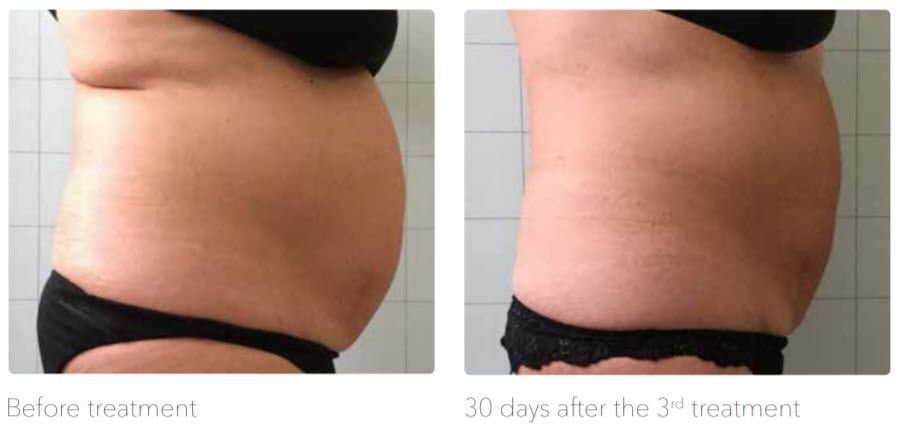 Vergleichsbilder eines Bauchs vor und nach einer Behandlung, links vor der Behandlung, rechts 30 Tage nach der dritten Behandlung.