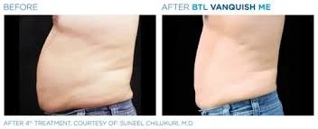 Vorher- und Nachher-Bild eines Bauchbereichs, deutliche Gewichtsabnahme sichtbar nach Behandlung.