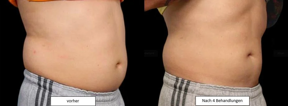 Vorher-Nachher-Bilder eines Bauchbereichs nach vier Behandlungen