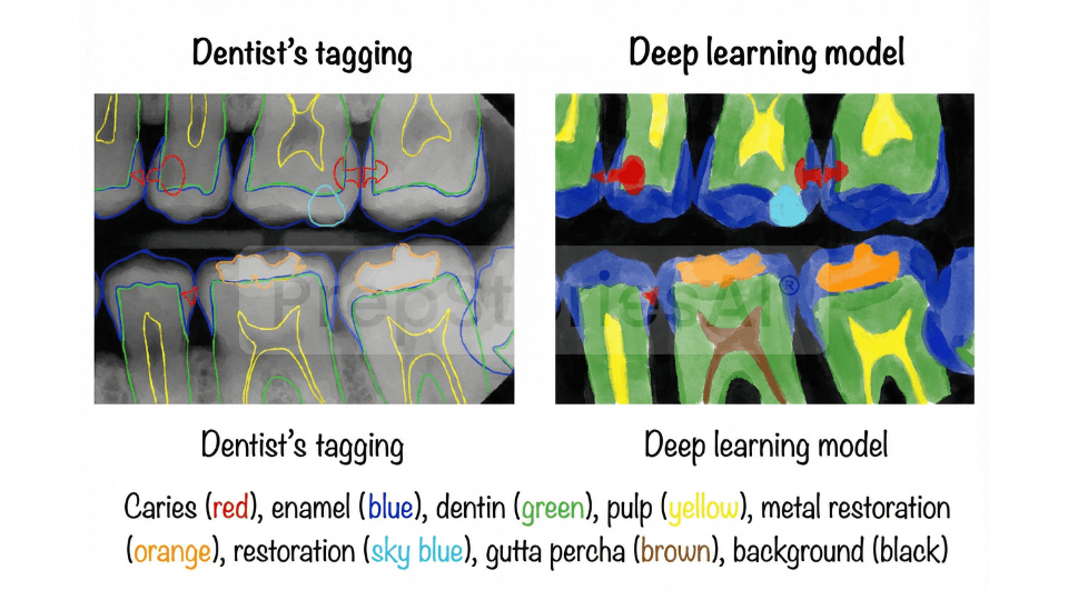 Comparison of dentist’s manual tagging and deep learning model for proximal caries detection on bitewing dental x-rays, highlighting how AI improves diagnostic accuracy in modern dentistry.
