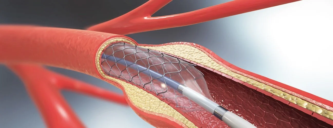 Medical diagram of a catheter inserted into a blood vessel with a stent.
