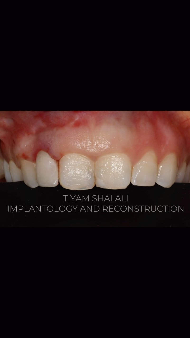 EDUCATIONAL CONTENT:
Extraction and immediate implant placement with temporary crown
The tooth🦷was removed as atraumatically as possible to keep bone and tissues intact🦴
Implant was placed with high torque for immediate temporization🔩
The sock