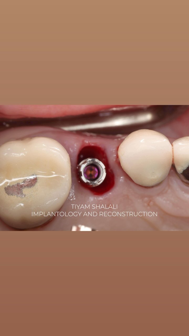 EDUCATIONAL CONTENT:
Extraction and immediate implant placement
Teeth should always be removed as atraumatically as possible to keep bone and tissues intact
Implants should be placed with high torque for immediate temporization
The socket may or