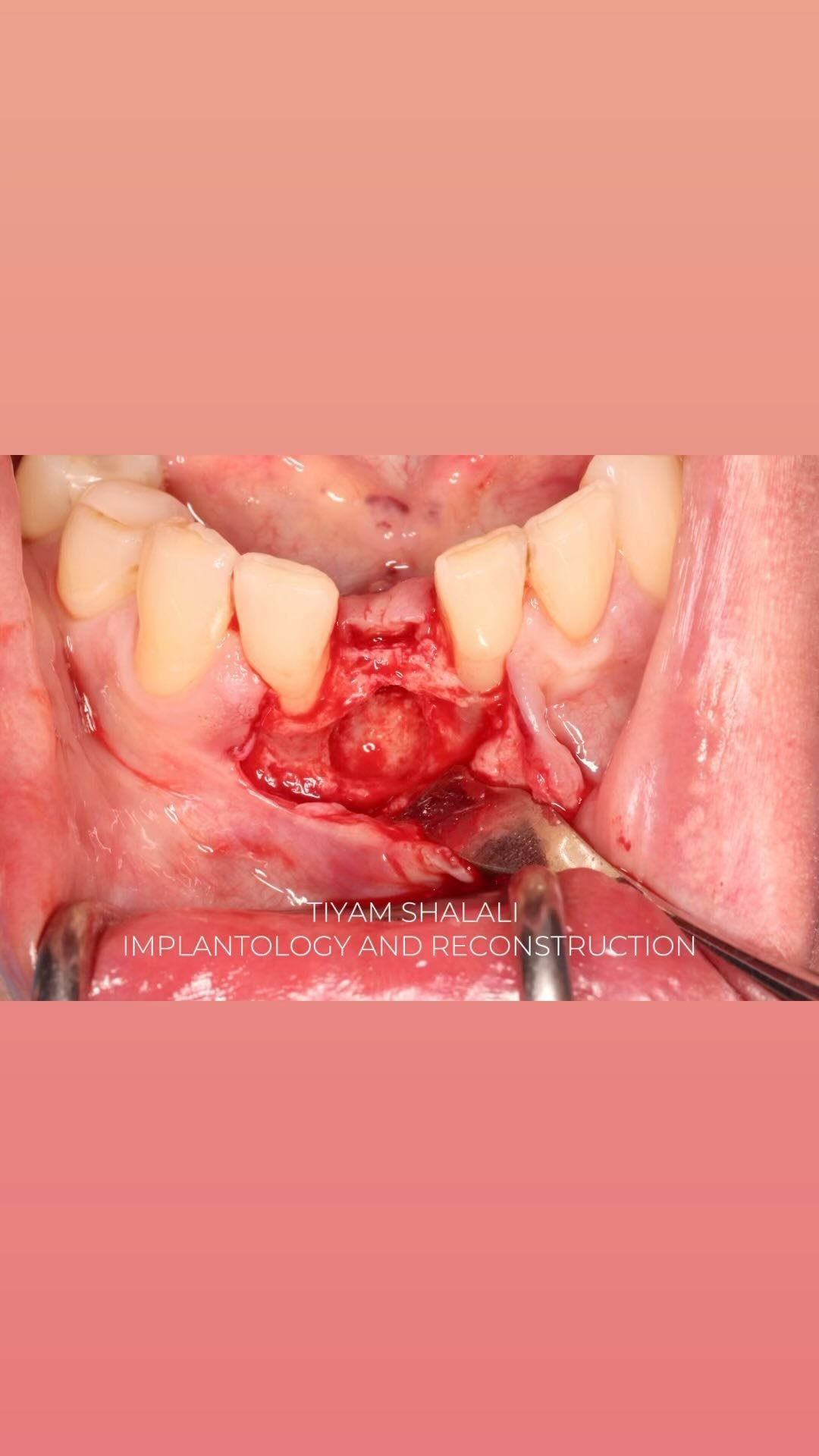 EDUCATIONAL CONTENT:
Implant placement and bone augmentation after cyst removal
Thorough cleaning and disinfection is needed when doing all at once
Coronal and apical fixation of the implant was possible providing high insertion torque
The second