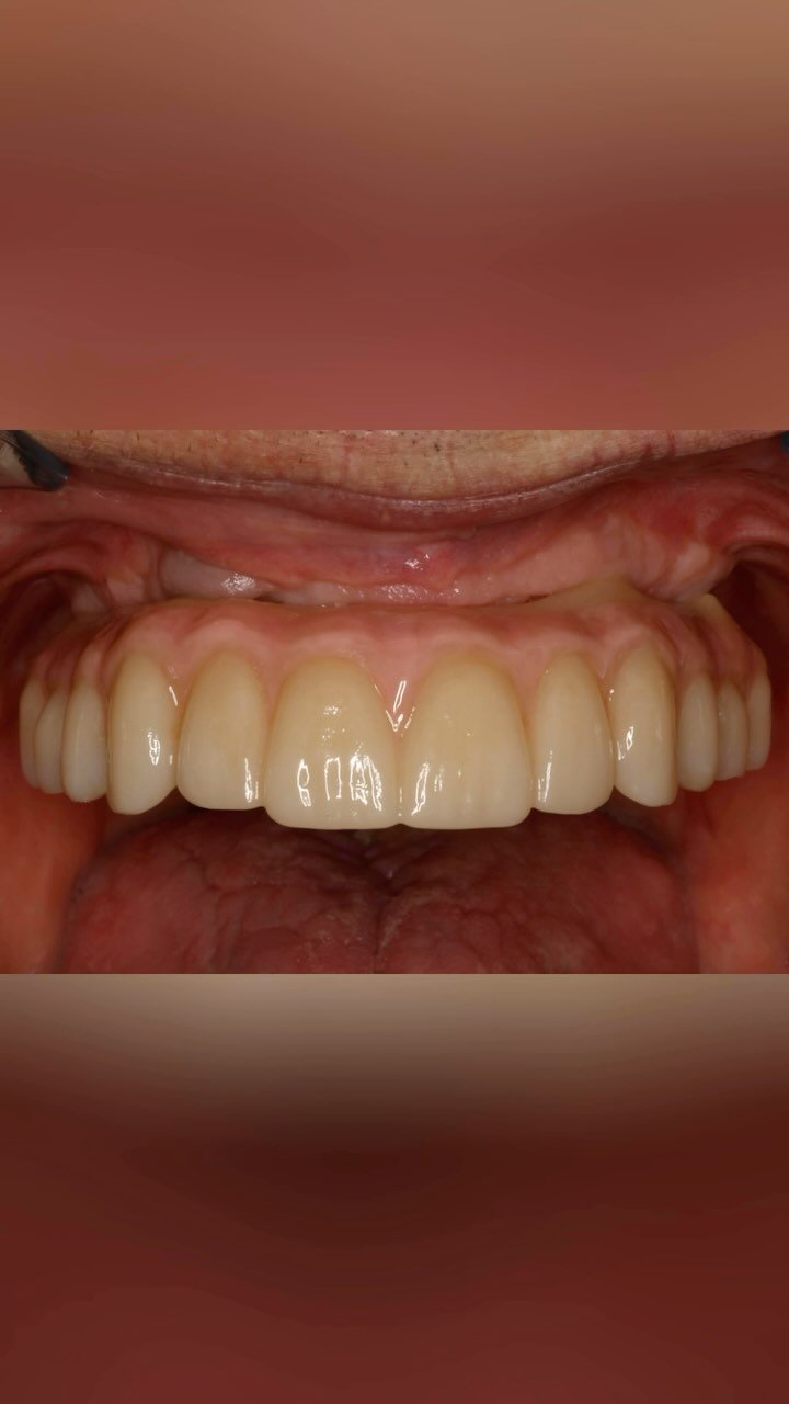 EDUCATIONAL CONTENT:
ALL-ON-4
Severe perio case, patient had not seen a dentist in 20 years
First, steps were taken to improve oral hygiene
Then extraction of all teeth, thorough cleaning and immediate implant placement was done.
Implants placed