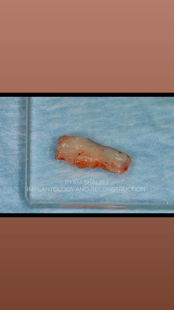 EDUCATIONAL CONTENT:
Extraction of incisor and immediate implant placement with temporary crown.
Tooth was fractured, removed atraumatically
Notice the lack of support and loss of dimensions on the buccal after extraction of the tooth ->
Implan