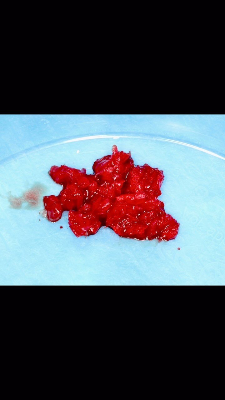 EDUCATIONAL CONTENT:
HORIZONTAL BONE AUGMENTATION
Autologous scrapings were harvested from the area with a bonescraper and were mixed 70:30 with xenograft. A membrane was tacked into place.
Finally, primary closure was achieved.
In 5 months, re-e