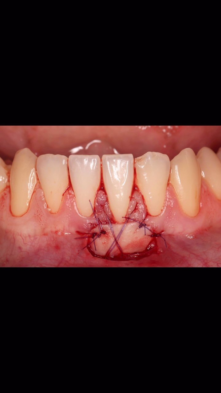 EDUCATIONAL CONTENT:
FREE GINGIVAL GRAFT
Share your thoughts🫶
#freegingivaltissuegraft #freegingivalgraft #gumsurgeons
#implantdentistry #implantology #implants #implantologia #immediateloading #immediateimplant #implantsurgery #dentalimplant #i