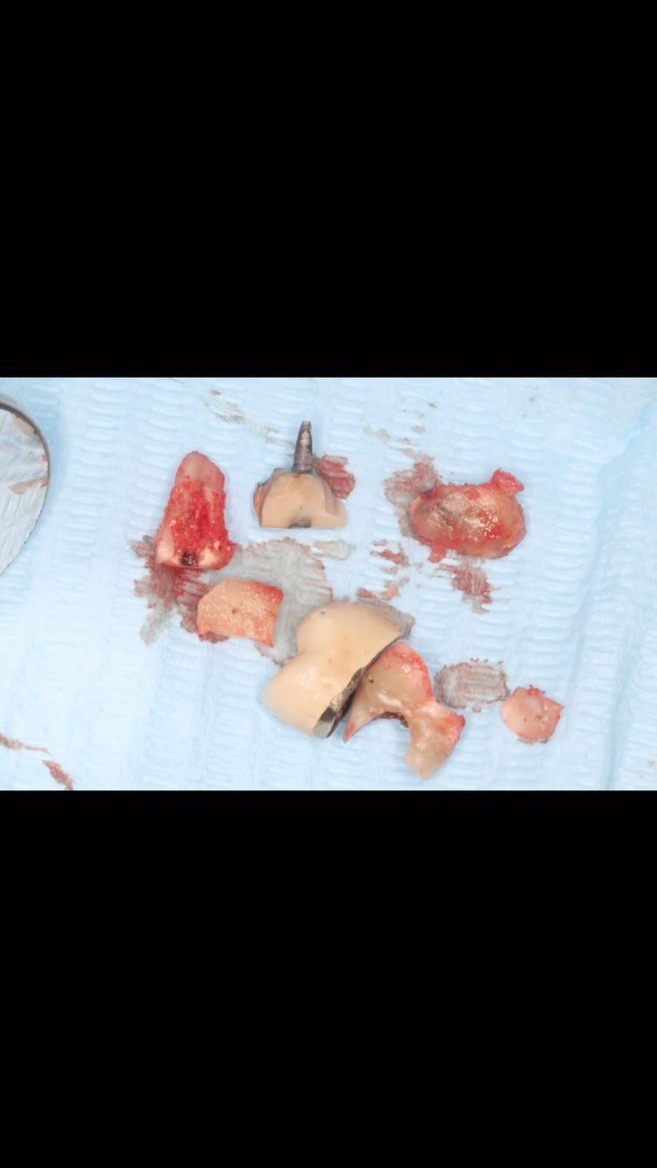 EDUCATIONAL CONTENT:
Extraction of premolar and immediate implant placement with temporary crown.
Implant placed with high torque ->
The socket was grafted with DBBM after implant placement ->
A temp crown was made to maintain the gingival