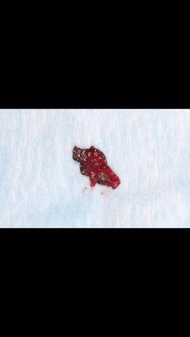 EDUCATIONAL CONTENT:
HOW TO DEAL WITH PERFORATION DURING SINUS ELEVATION
Upon entry granulous tissue was noticed from probably a former oro-antral communication that healed improperly.
Autologous scrapings were harvested from the area during sinus