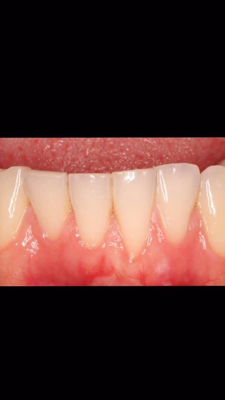 EDUCATIONAL CONTENT:
RECESSION COVERAGE VIA LATERAL TUNNEL (SCULEAN)
CTG was harvested from the palate
CTG placed in the lateral tunnel, Sculean technique
Sutured with 6/0 prolene
We covered nearly 6mm of recession with this technique
Last pic