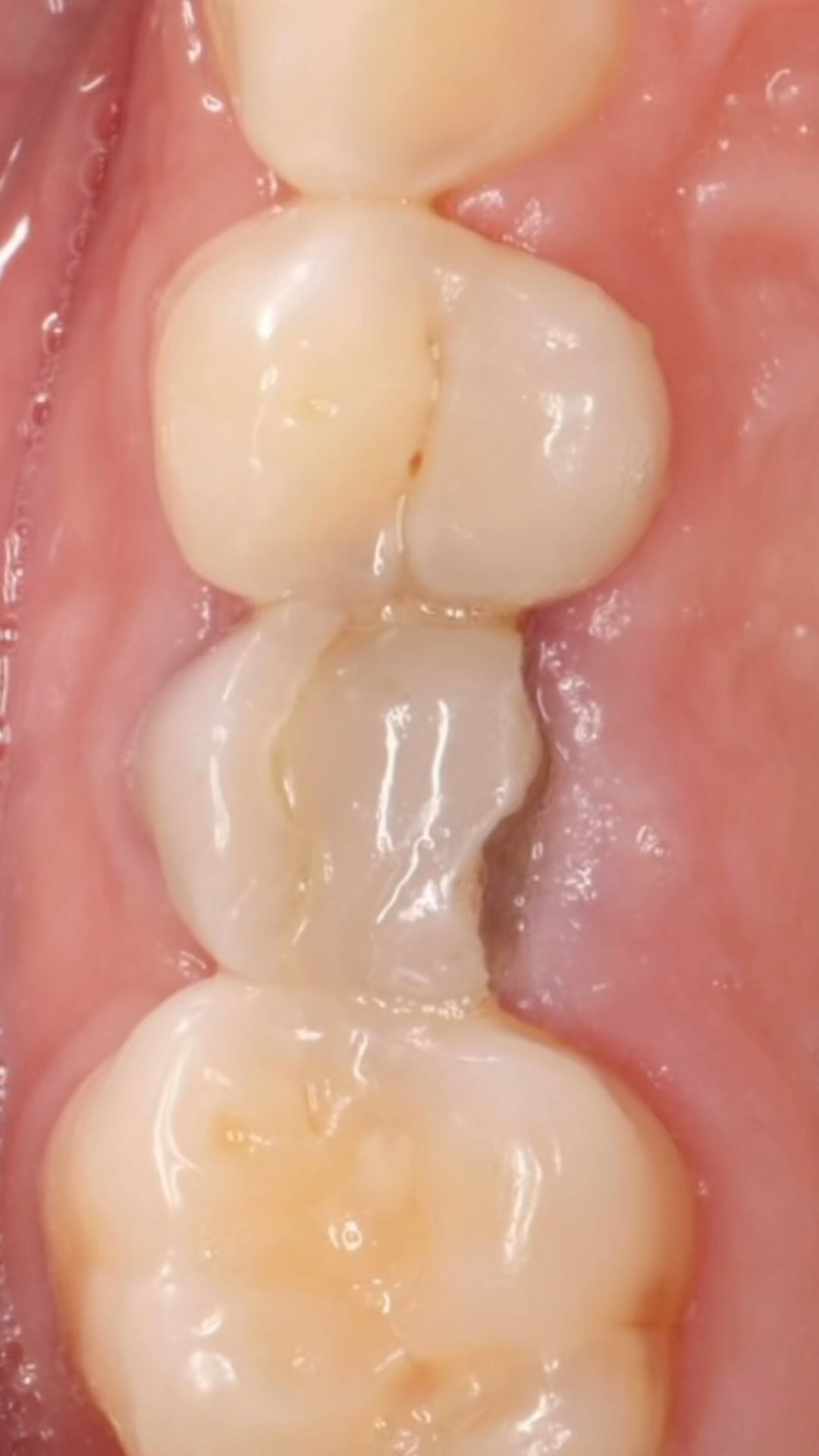 EDUCATIONAL CONTENT:
Extraction of premolar and immediate implant placement with temporary crown.
Implant placed with high torque ->
The socket was grafted with DBBM after implant placement ->
A temp crown was made to maintain the gingival